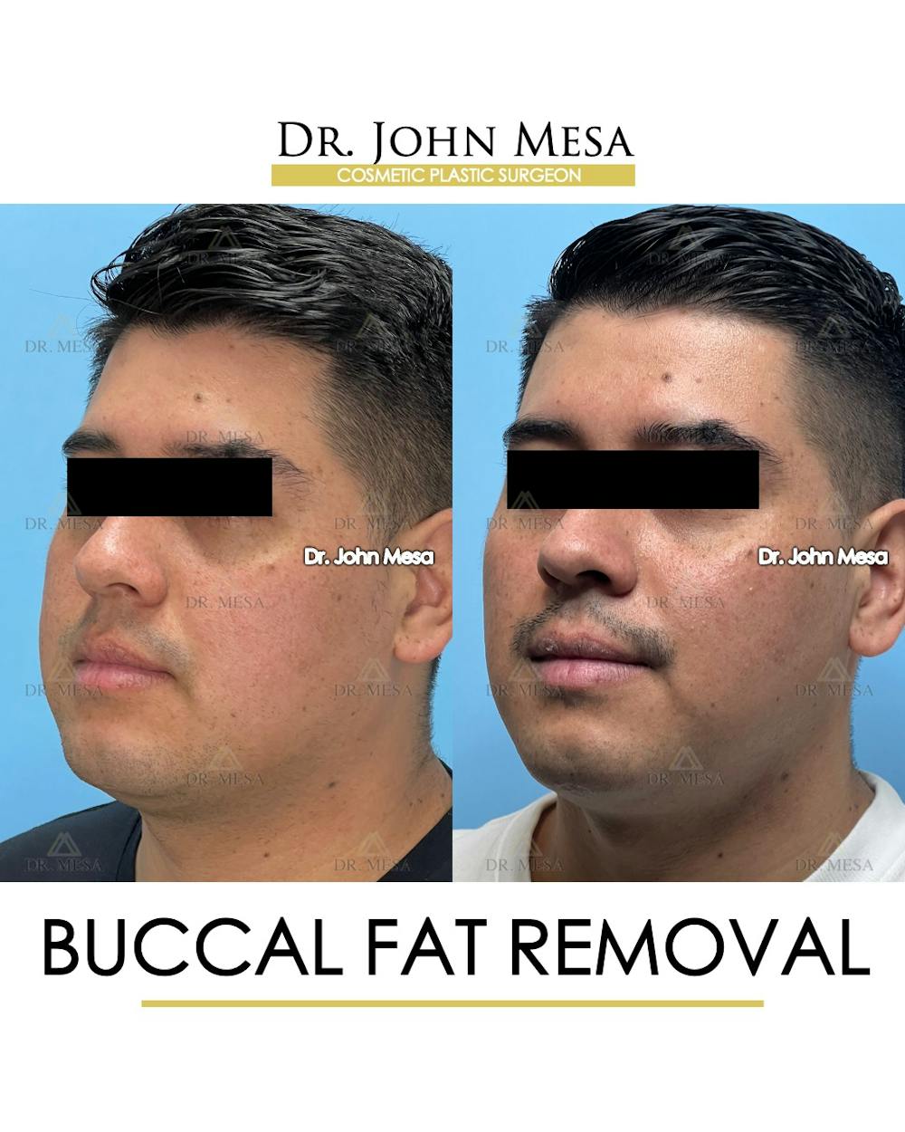 Buccal Fat Pad Removal for Men Before & After Gallery - Patient 281102 - Image 5