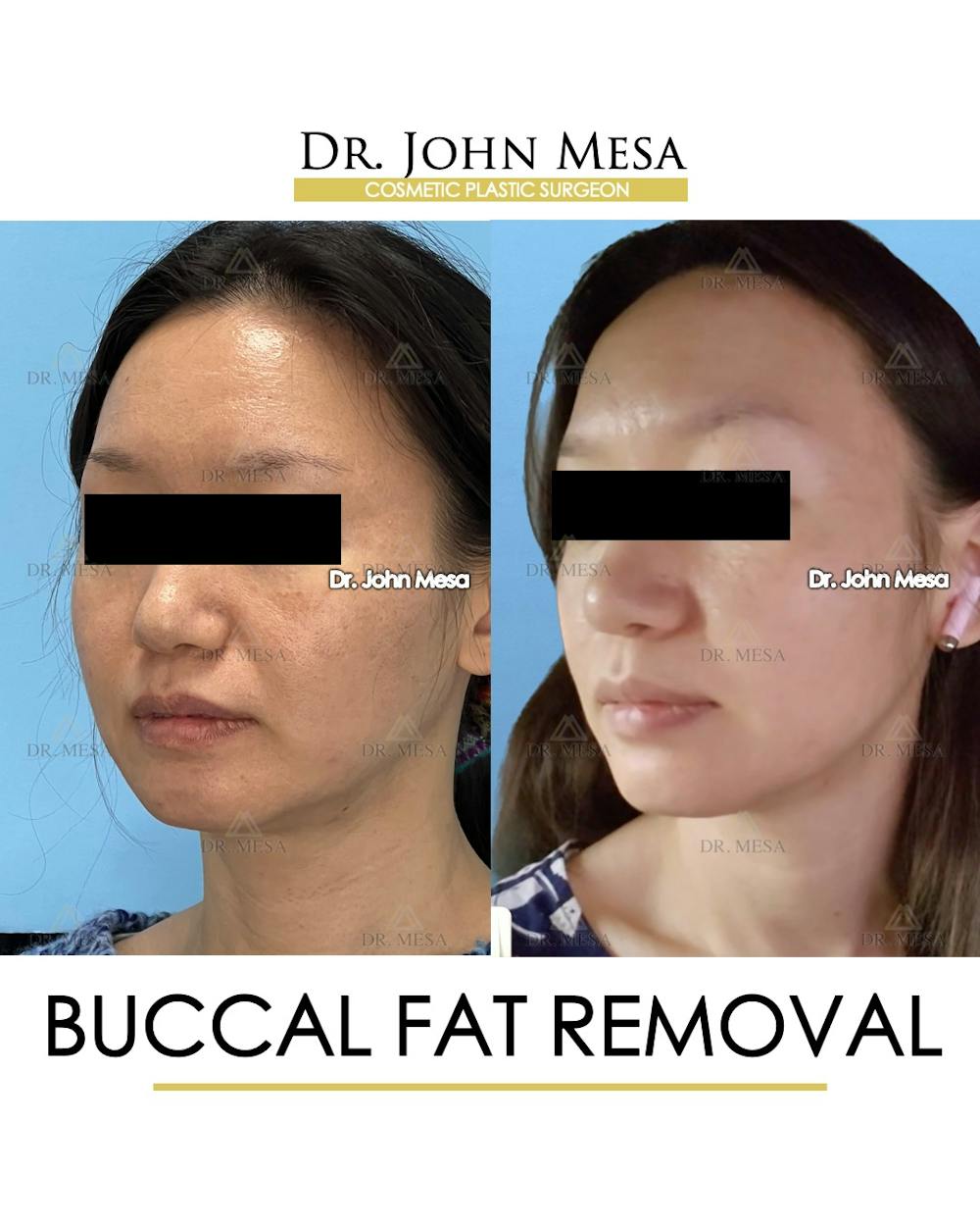 Buccal Fat Pad Removal Before & After Gallery - Patient 302040 - Image 4