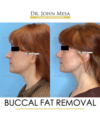 Buccal Fat Pad Removal Before & After Gallery - Patient 209841 - Image 6