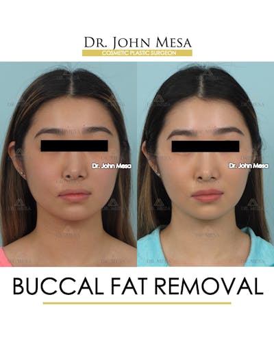 Buccal Fat Pad Removal Before & After Gallery - Patient 309298 - Image 1
