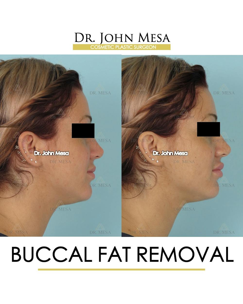 Buccal Fat Pad Removal Before & After Gallery - Patient 234336 - Image 3