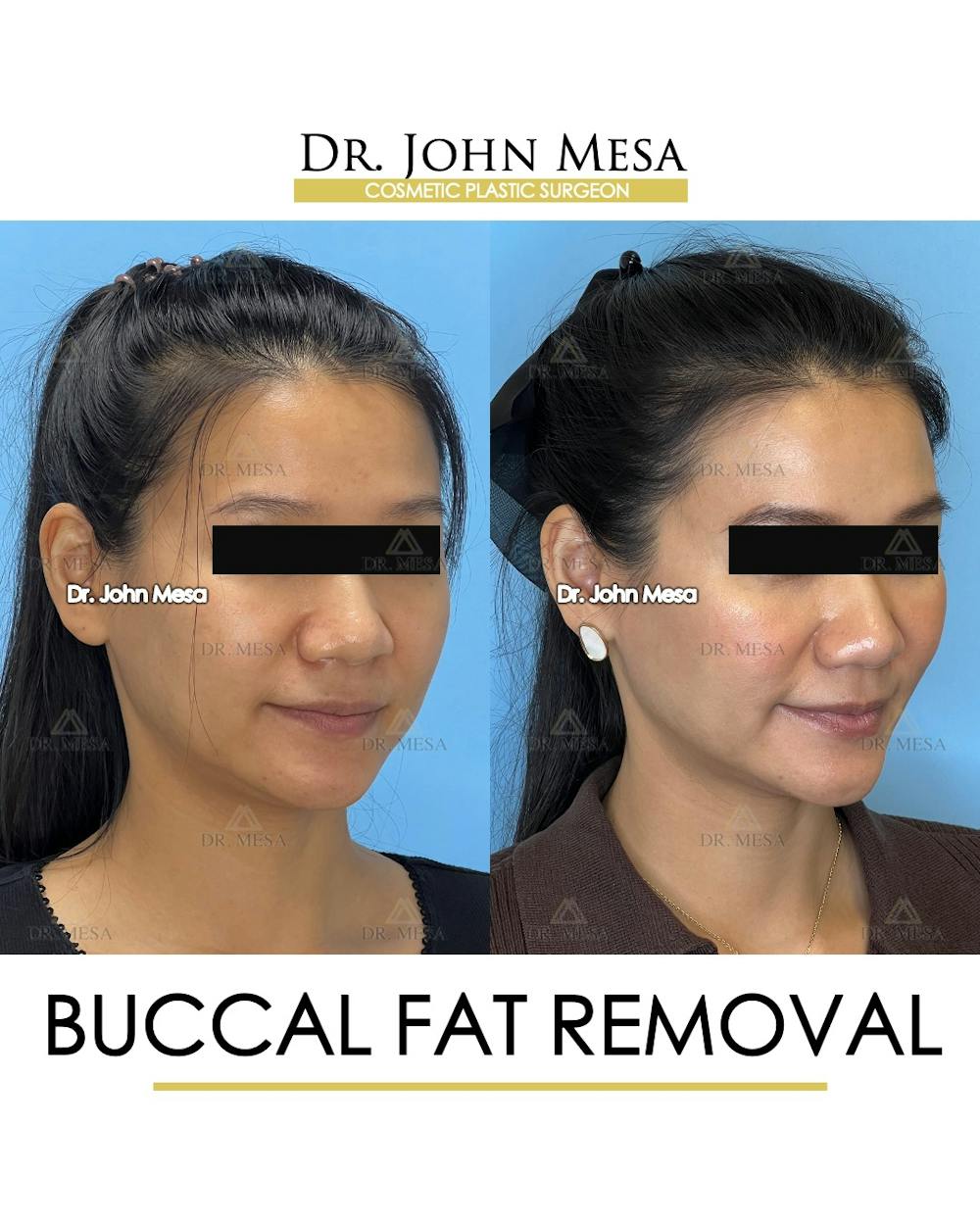 Buccal Fat Pad Removal Before & After Gallery - Patient 278613 - Image 3