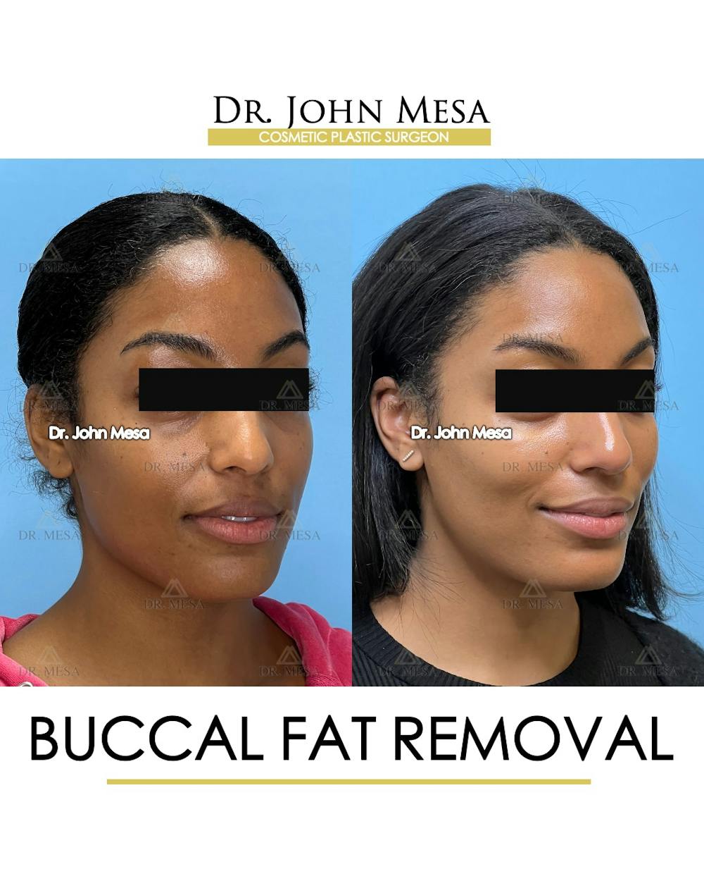 Buccal Fat Pad Removal Before & After Gallery - Patient 927675 - Image 3
