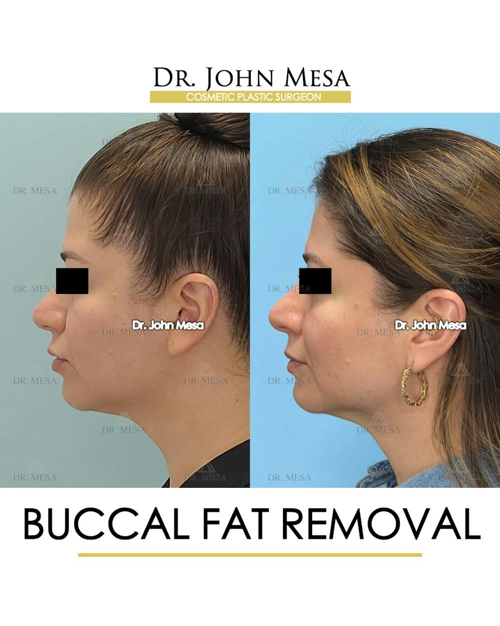 Buccal Fat Pad Removal Before & After Gallery - Patient 163284 - Image 5