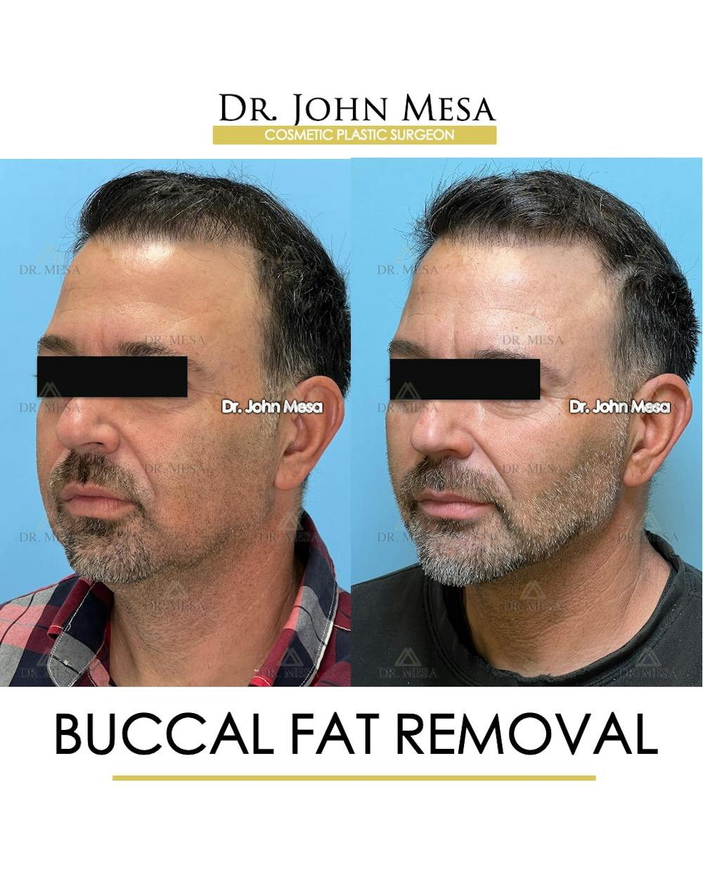 Buccal Fat Pad Removal for Men Before & After Gallery - Patient 154763 - Image 5