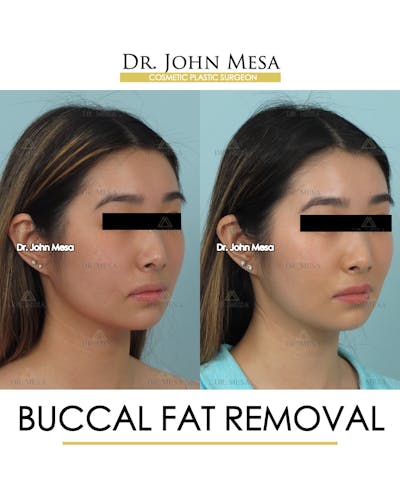 Buccal Fat Pad Removal Before & After Gallery - Patient 309298 - Image 2