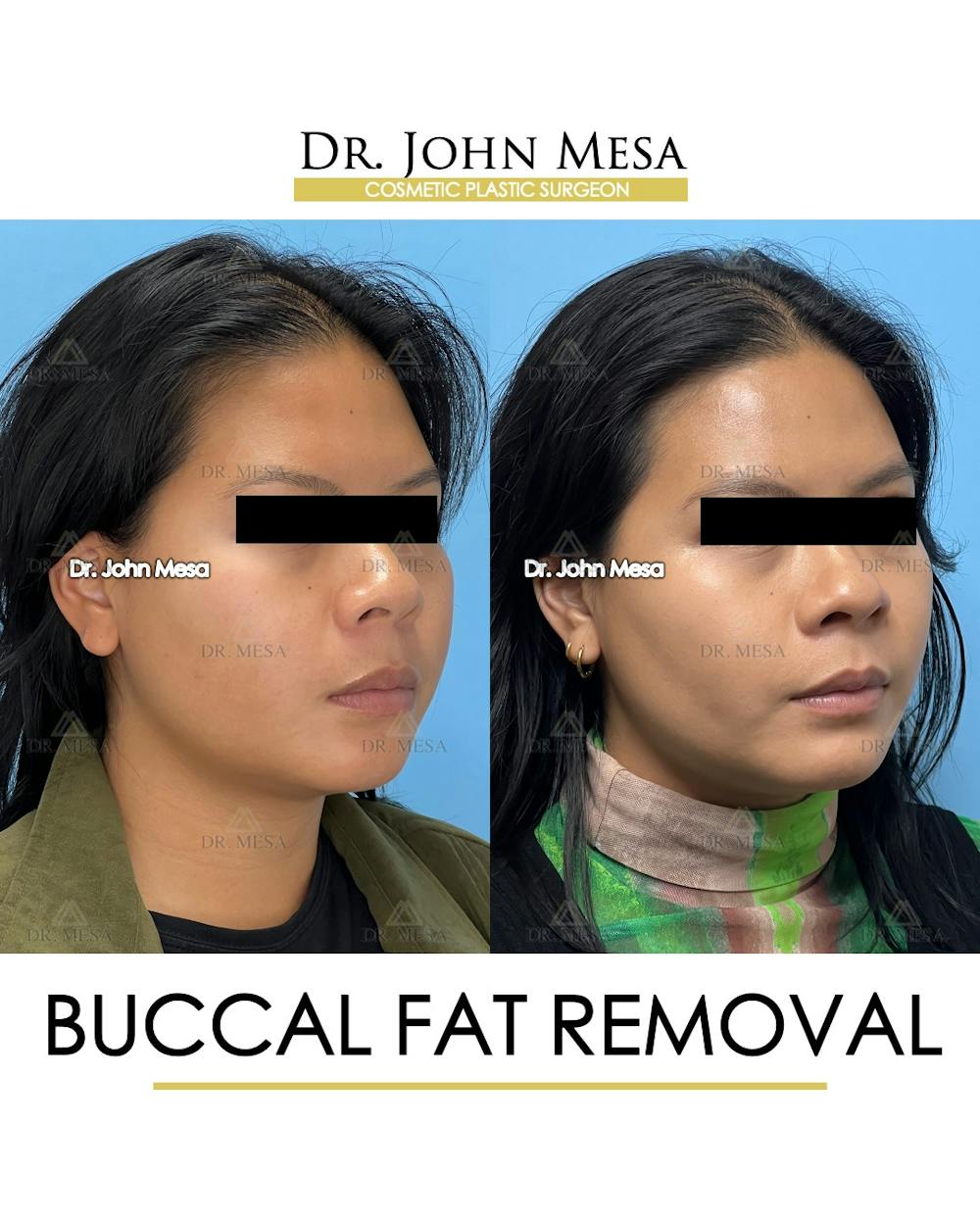 Buccal Fat Pad Removal Before & After Gallery - Patient 392039 - Image 3