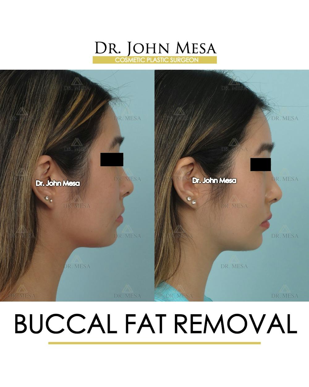 Buccal Fat Pad Removal Before & After Gallery - Patient 309298 - Image 3