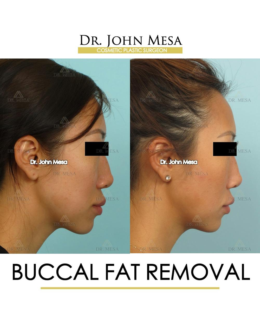 Buccal Fat Pad Removal Before & After Gallery - Patient 448531 - Image 3