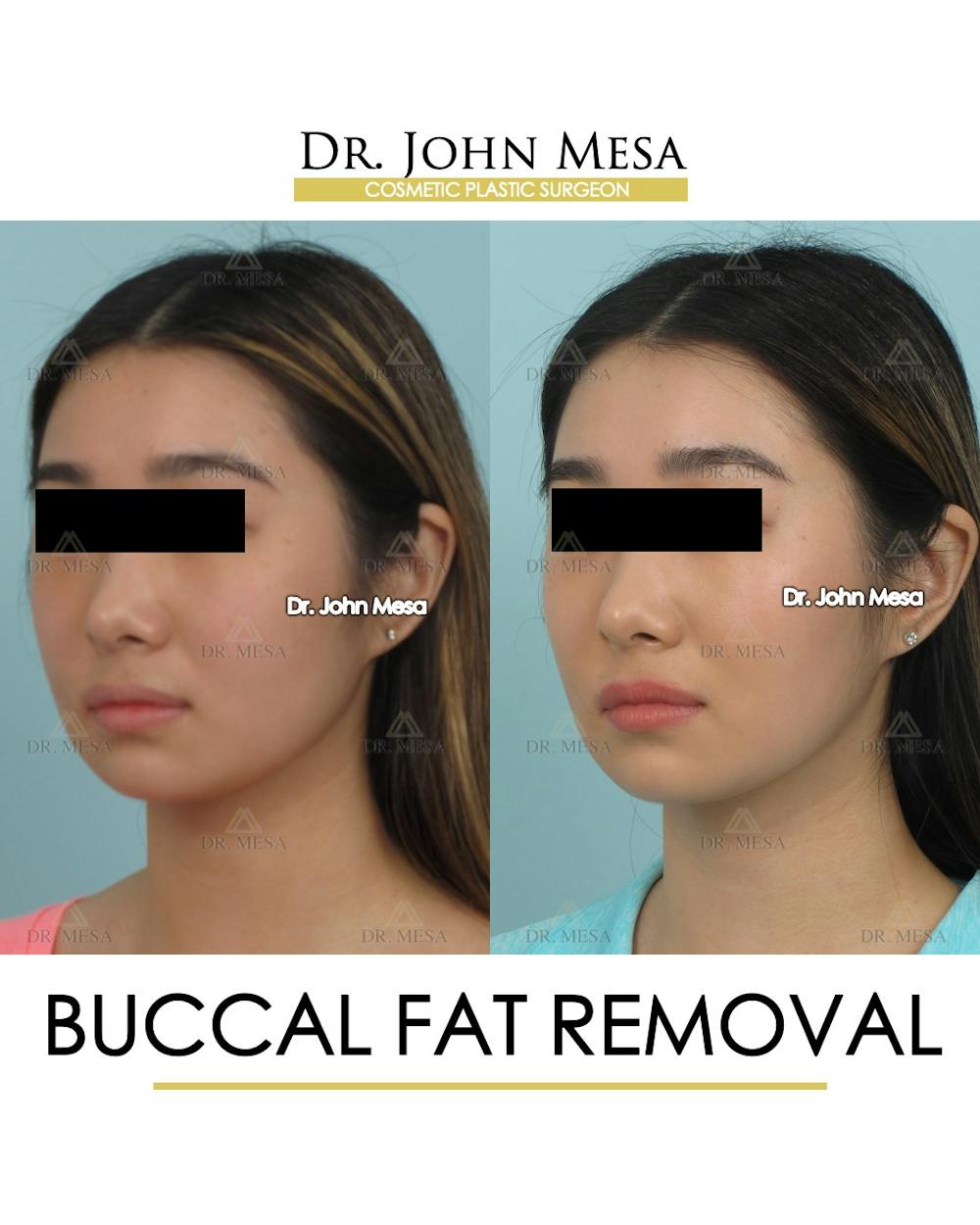 Buccal Fat Pad Removal Before & After Gallery - Patient 309298 - Image 4