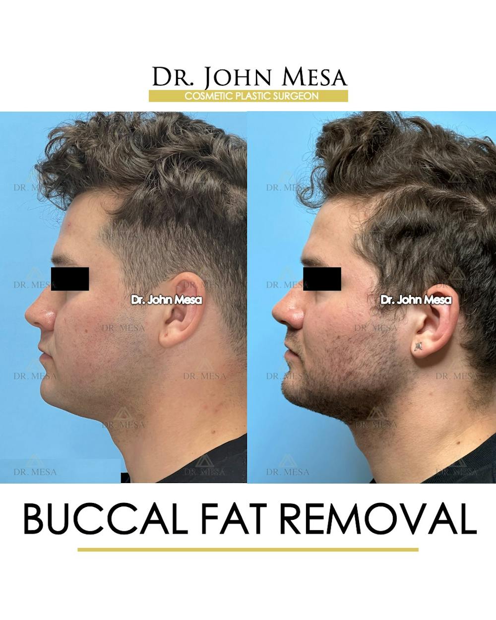 Buccal Fat Pad Removal for Men Before & After Gallery - Patient 185020 - Image 6