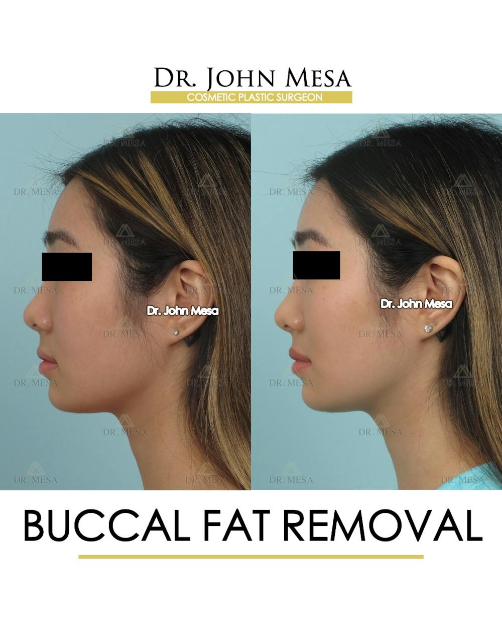 Buccal Fat Pad Removal Before & After Gallery - Patient 309298 - Image 5