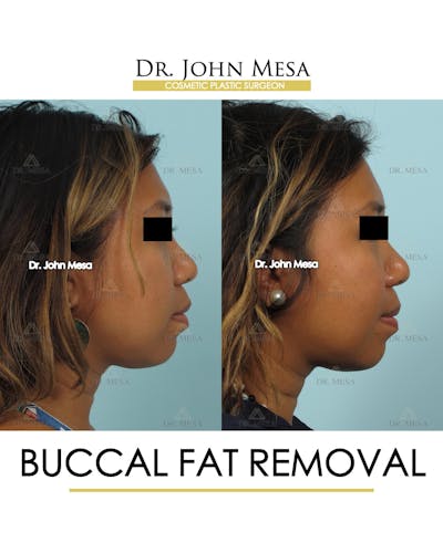 Buccal Fat Pad Removal Before & After Gallery - Patient 388739 - Image 2