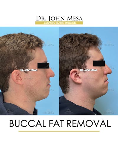 Buccal Fat Pad Removal for Men Before & After Gallery - Patient 127636 - Image 4