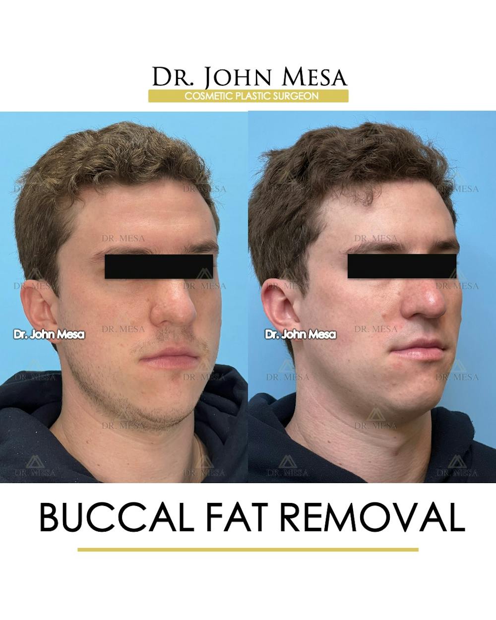 Buccal Fat Pad Removal for Men Before & After Gallery - Patient 127636 - Image 3