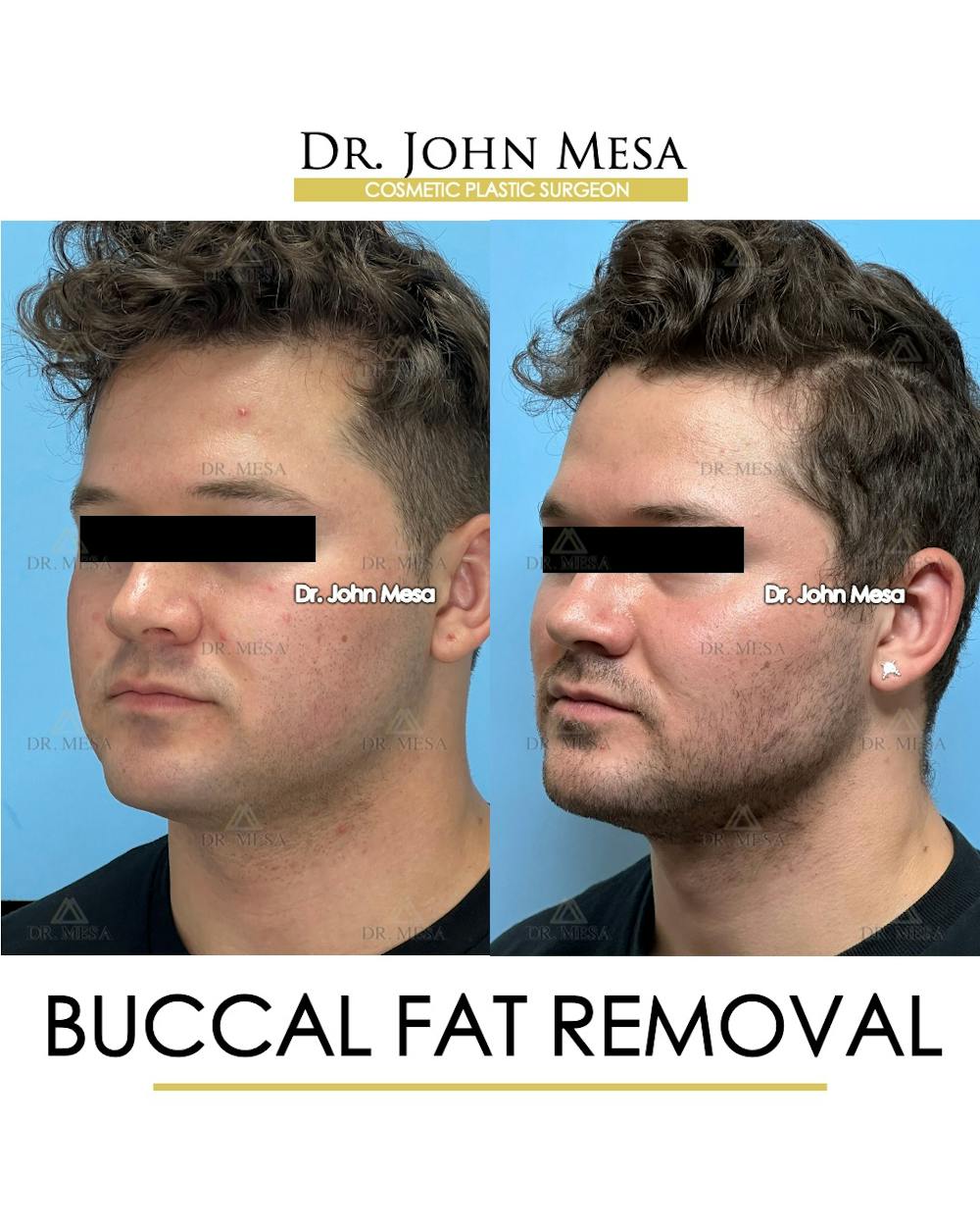 Buccal Fat Pad Removal for Men Before & After Gallery - Patient 185020 - Image 5