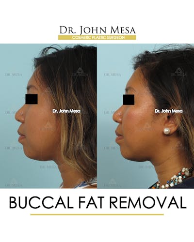 Buccal Fat Pad Removal Before & After Gallery - Patient 388739 - Image 4