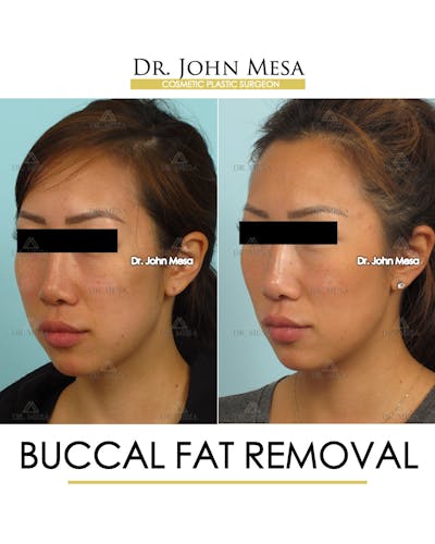 Buccal Fat Pad Removal Before & After Gallery - Patient 448531 - Image 4