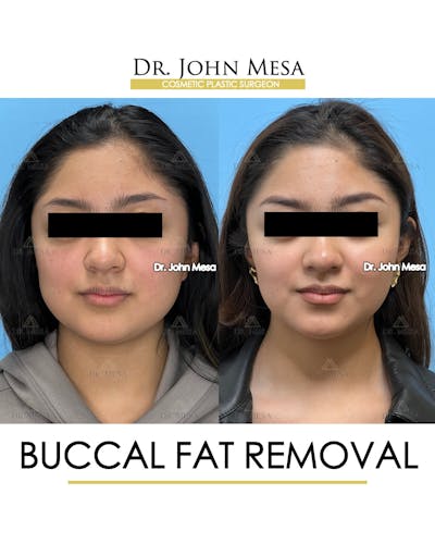 Buccal Fat Pad Removal Before & After Gallery - Patient 155744 - Image 1