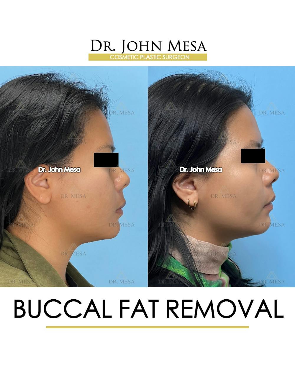 Buccal Fat Pad Removal Before & After Gallery - Patient 392039 - Image 4