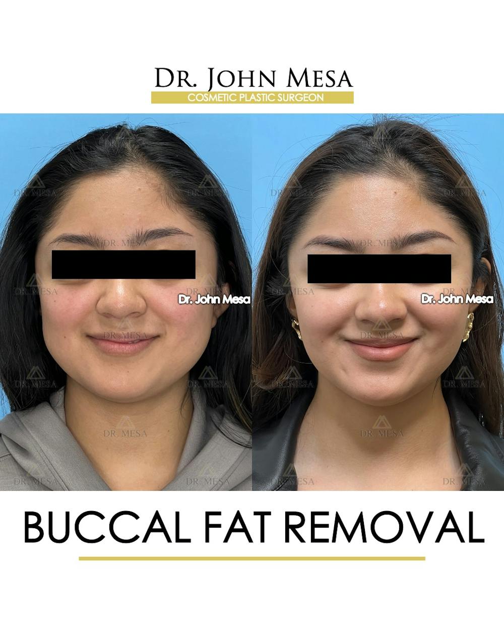Buccal Fat Pad Removal Before & After Gallery - Patient 155744 - Image 2