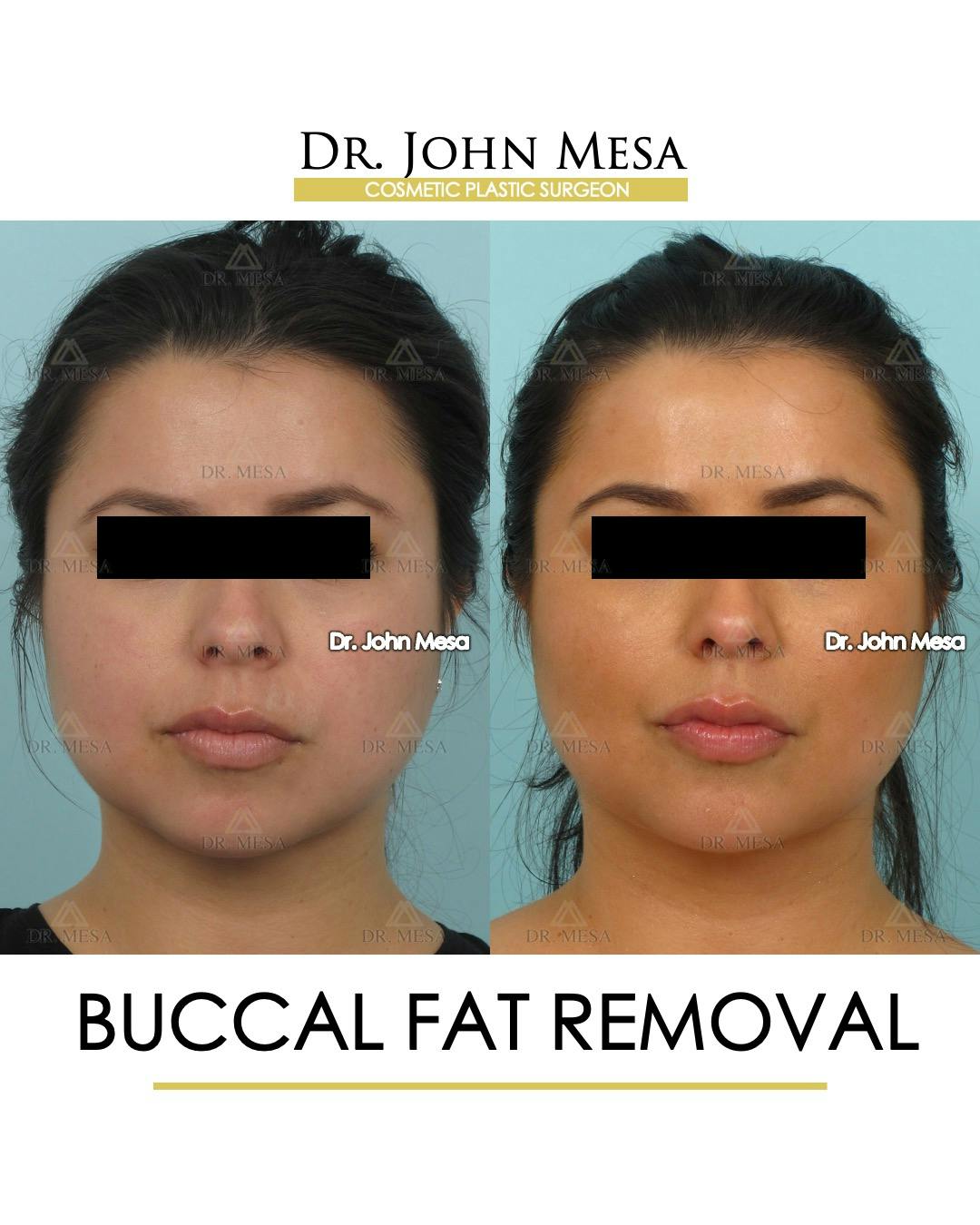 Buccal Fat Pad Removal Before & After Gallery - Patient 120998 - Image 1