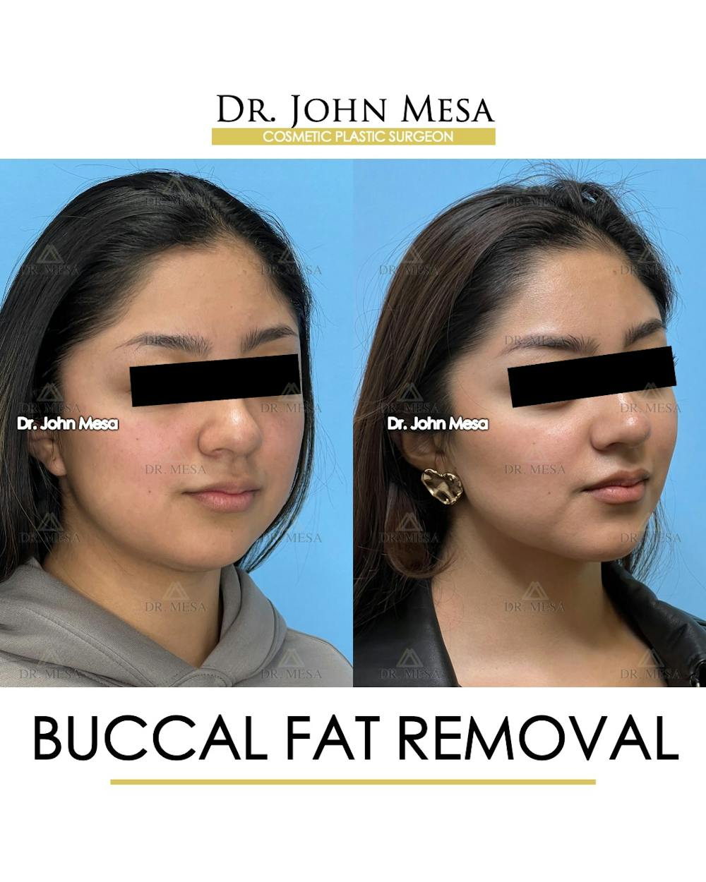 Buccal Fat Pad Removal Before & After Gallery - Patient 155744 - Image 3