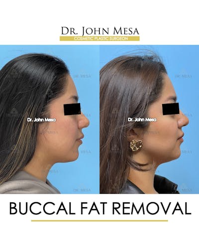 Buccal Fat Pad Removal Before & After Gallery - Patient 155744 - Image 4