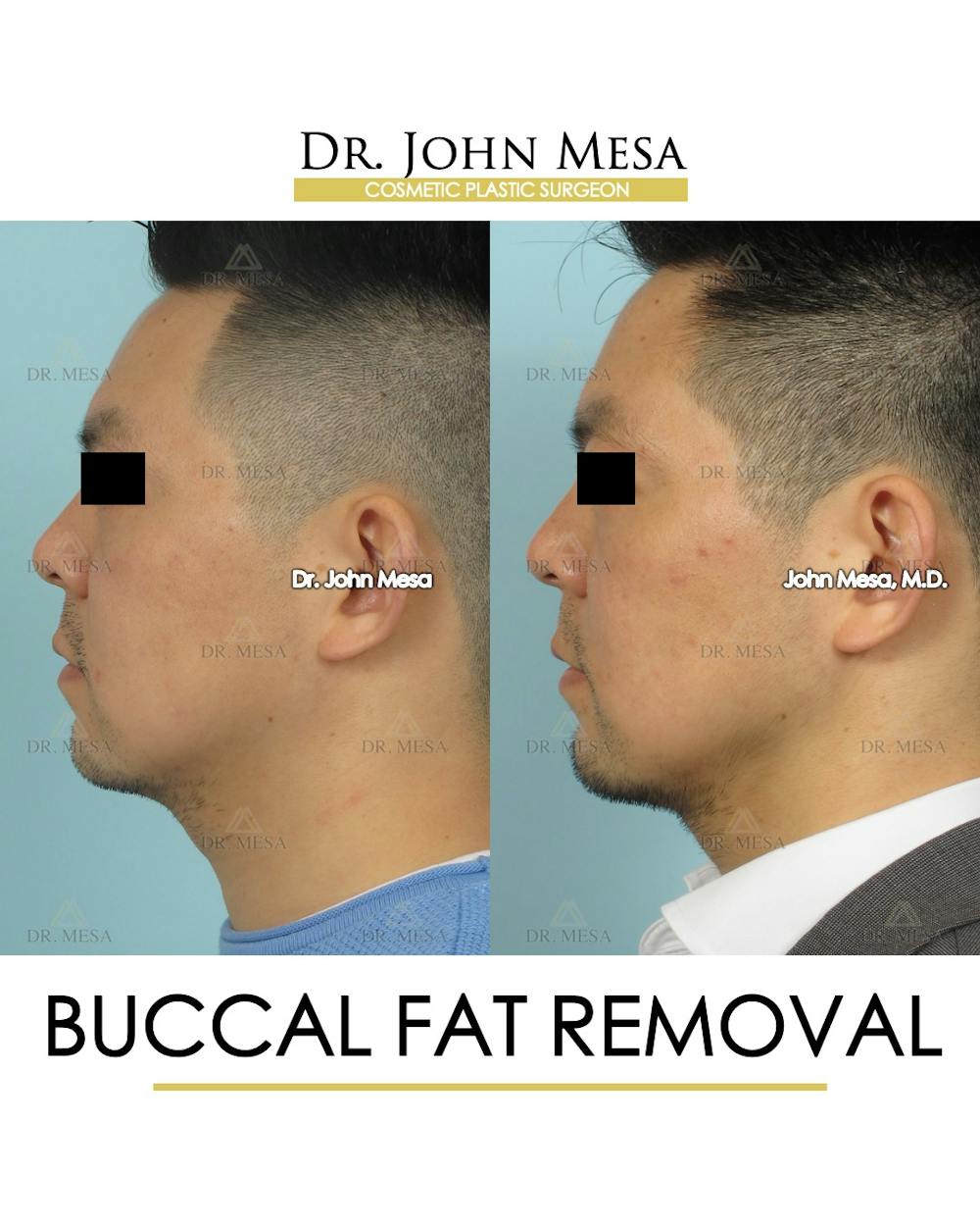 Buccal Fat Pad Removal for Men Before & After Gallery - Patient 248585 - Image 5