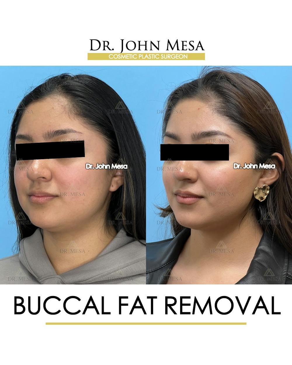 Buccal Fat Pad Removal Before & After Gallery - Patient 155744 - Image 5