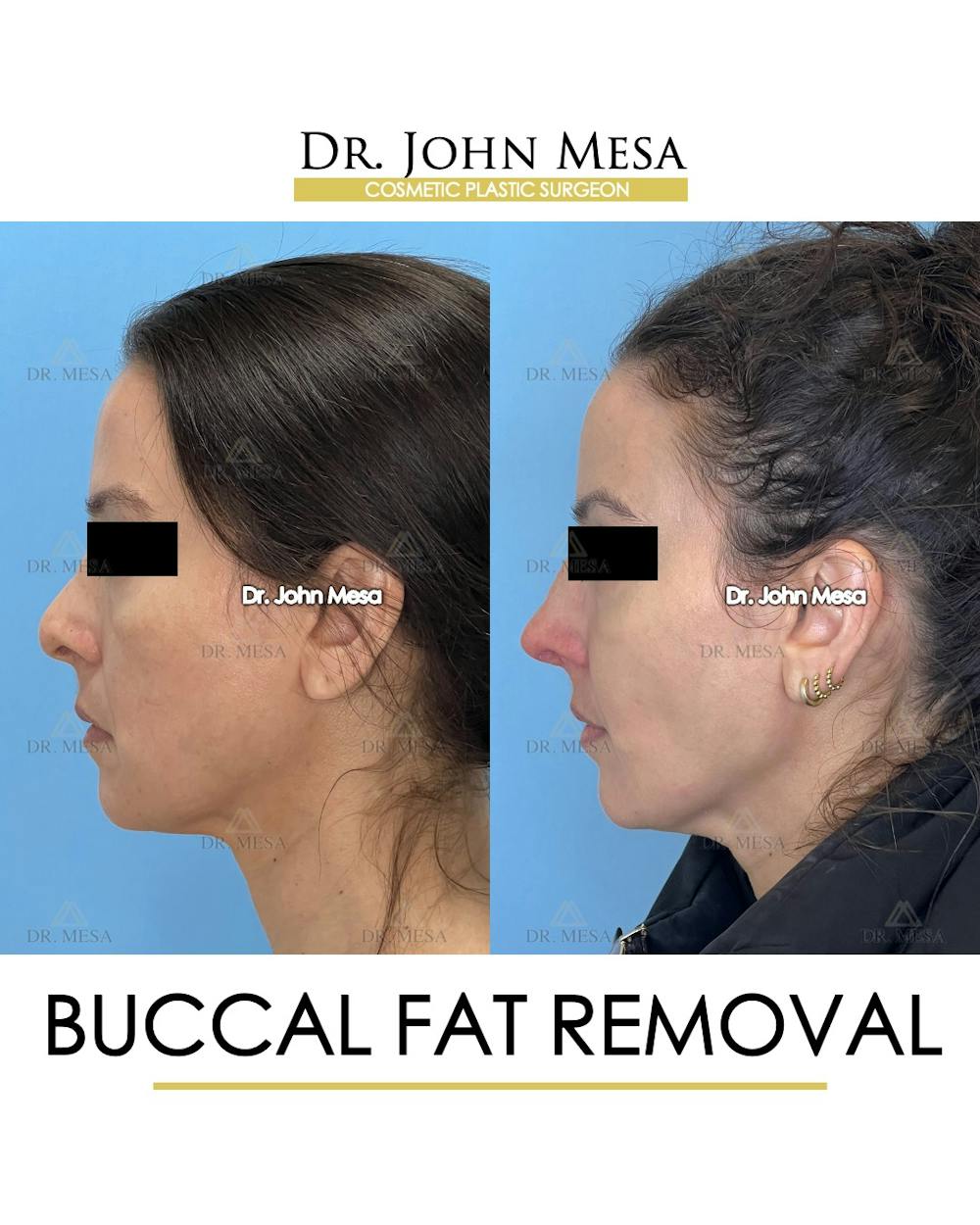 Buccal Fat Pad Removal Before & After Gallery - Patient 158969 - Image 5