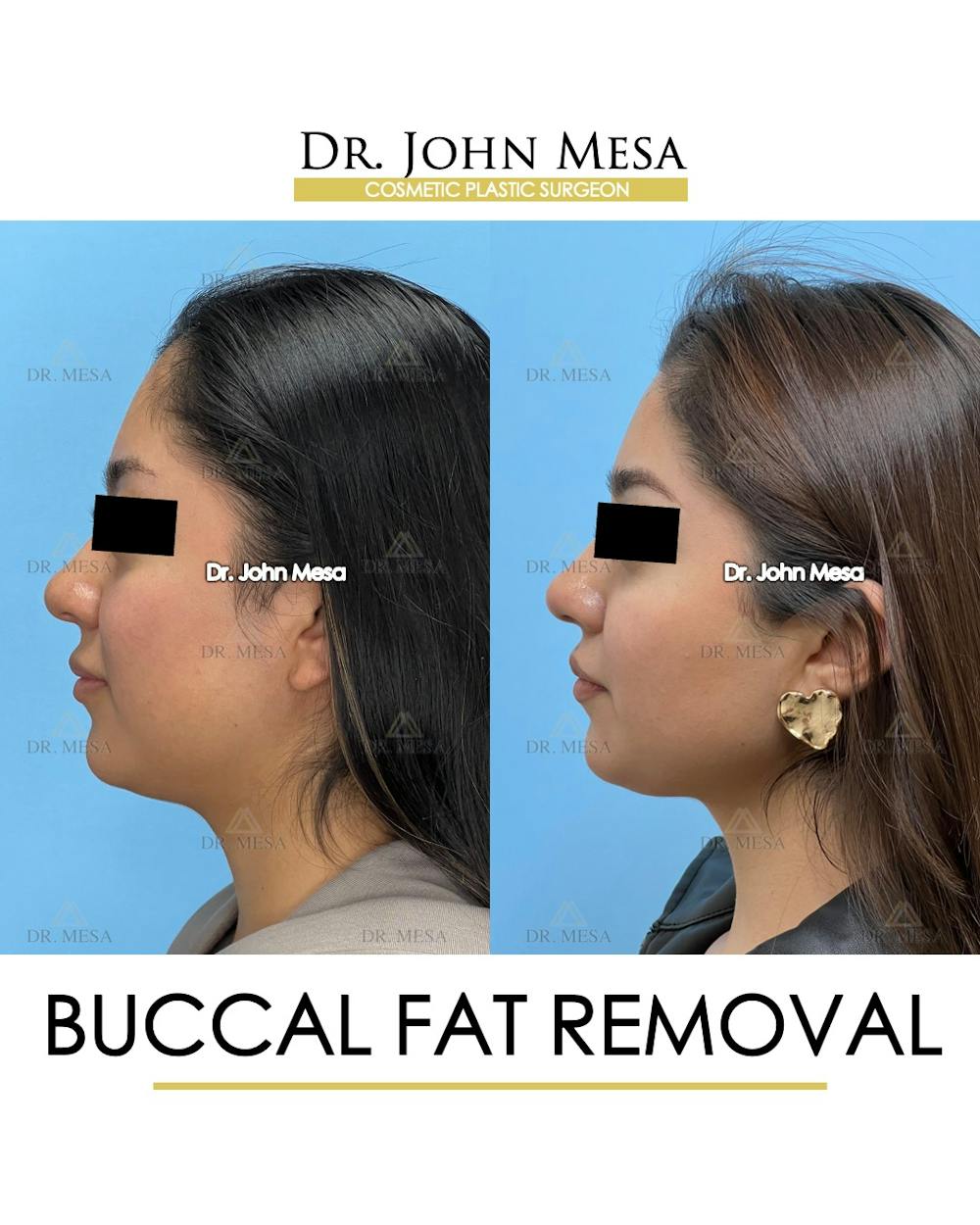 Buccal Fat Pad Removal Before & After Gallery - Patient 155744 - Image 6