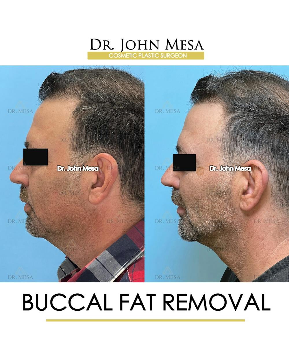 Buccal Fat Pad Removal for Men Before & After Gallery - Patient 154763 - Image 6