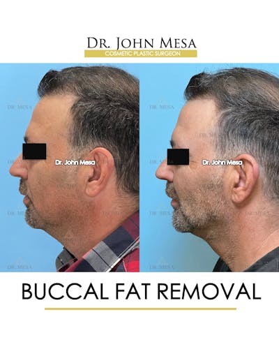 Buccal Fat Pad Removal for Men Before & After Gallery - Patient 154763 - Image 6