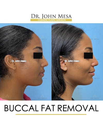 Buccal Fat Pad Removal Before & After Gallery - Patient 927675 - Image 4