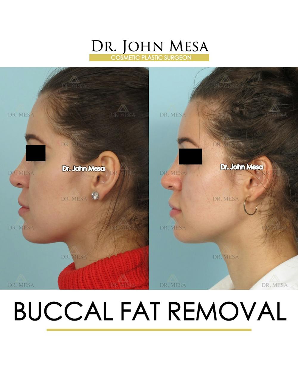 Buccal Fat Pad Removal Before & After Gallery - Patient 293010 - Image 5
