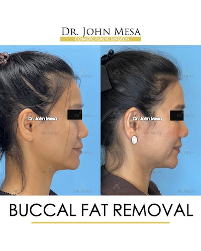 Buccal Fat Pad Removal Before & After Gallery - Patient 278613 - Image 4