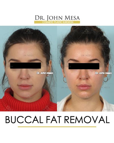 Buccal Fat Pad Removal Before & After Gallery - Patient 293010 - Image 1