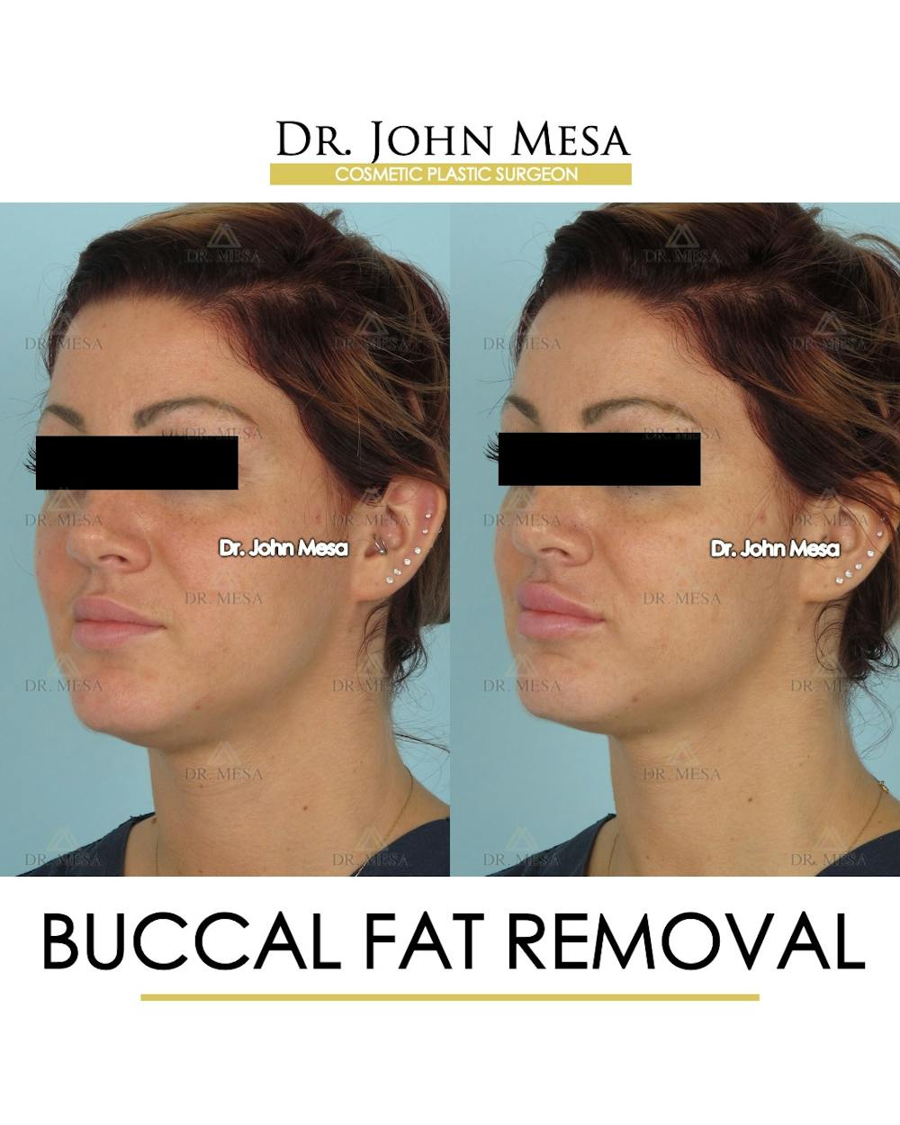 Buccal Fat Pad Removal Before & After Gallery - Patient 234336 - Image 4