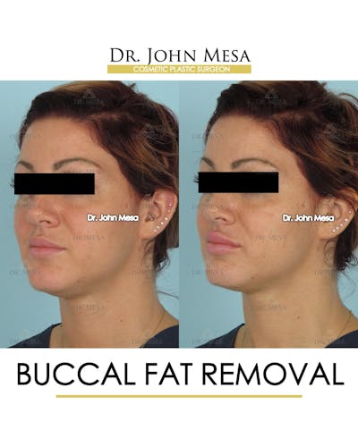 Buccal Fat Pad Removal Before & After Gallery - Patient 234336 - Image 4