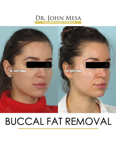 Buccal Fat Pad Removal Before & After Gallery - Patient 293010 - Image 2
