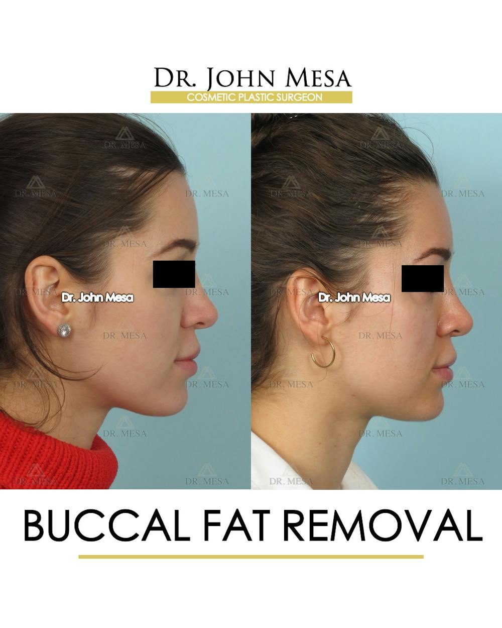 Buccal Fat Pad Removal Before & After Gallery - Patient 293010 - Image 3