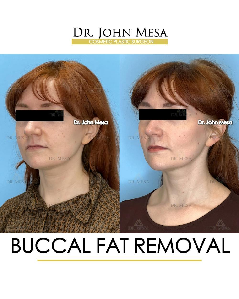 Buccal Fat Pad Removal Before & After Gallery - Patient 209841 - Image 5
