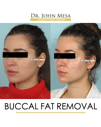 Buccal Fat Pad Removal Before & After Gallery - Patient 293010 - Image 4