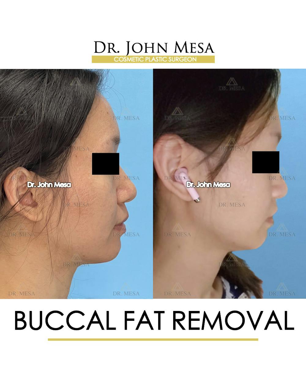 Buccal Fat Pad Removal Before & After Gallery - Patient 302040 - Image 3