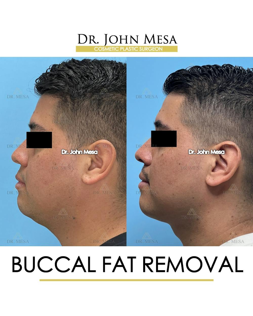 Buccal Fat Pad Removal for Men Before & After Gallery - Patient 281102 - Image 6