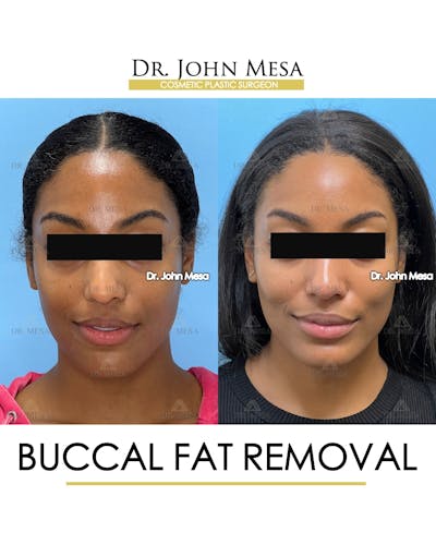 Buccal Fat Pad Removal Before & After Gallery - Patient 927675 - Image 1