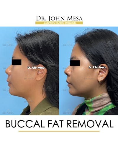 Buccal Fat Pad Removal Before & After Gallery - Patient 392039 - Image 6