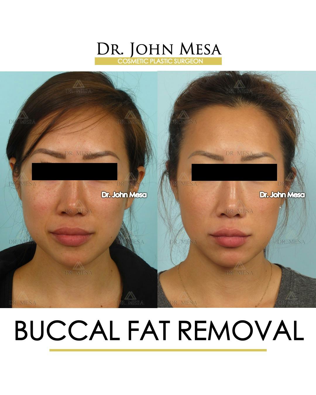 Buccal Fat Pad Removal Before & After Gallery - Patient 448531 - Image 1
