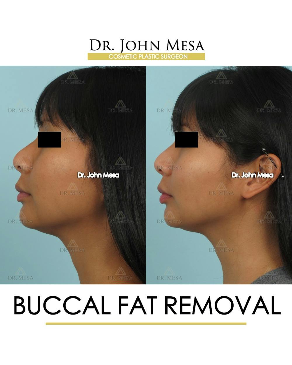 Buccal Fat Pad Removal Before & After Gallery - Patient 793933 - Image 5